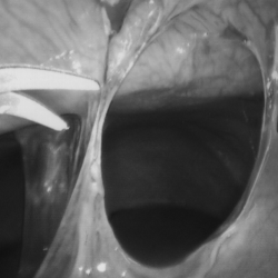 Laparoscopic lysis of adhesions cpt code