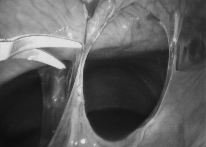 Laparoscopic lysis of adhesions cpt code