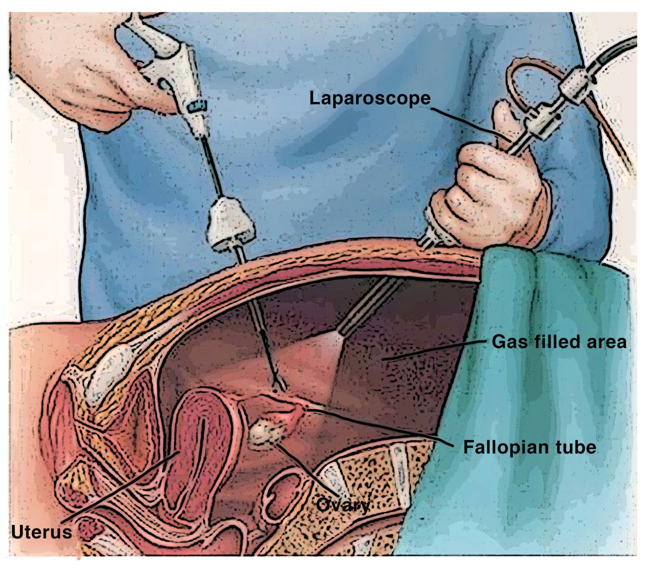 Laparoscopic lysis of adhesions cpt code